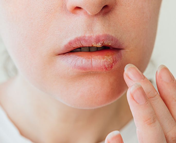 Герпес на губах: что это, причины, симптомы, лечение | РБК Стиль